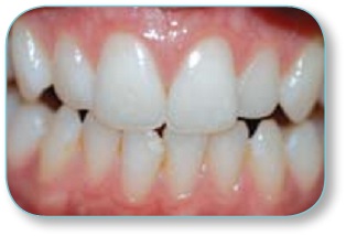 Zęby po używaniu przez 4 tygodnie szczoteczki sonicznej